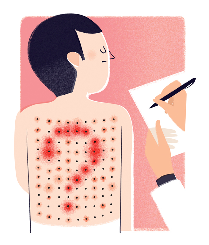 Editorial illustration on allergic reaction and prick test